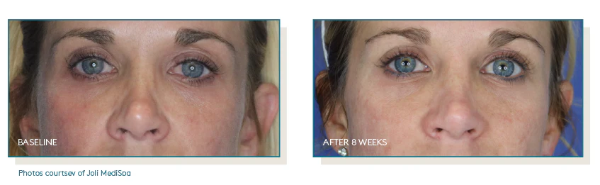 Pep-Up_ba_protocol-b_joli-medispa.png.webp